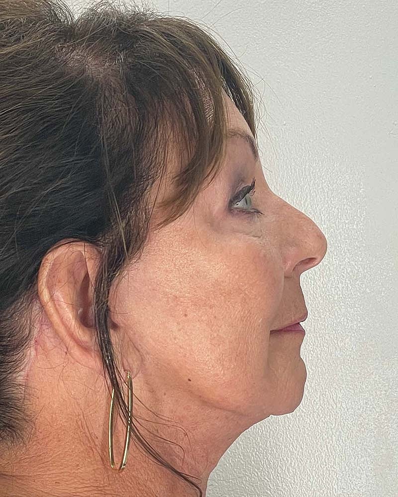 Blepharoplasty Before & After