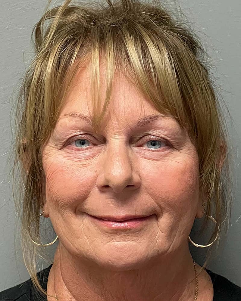 Blepharoplasty Before & After