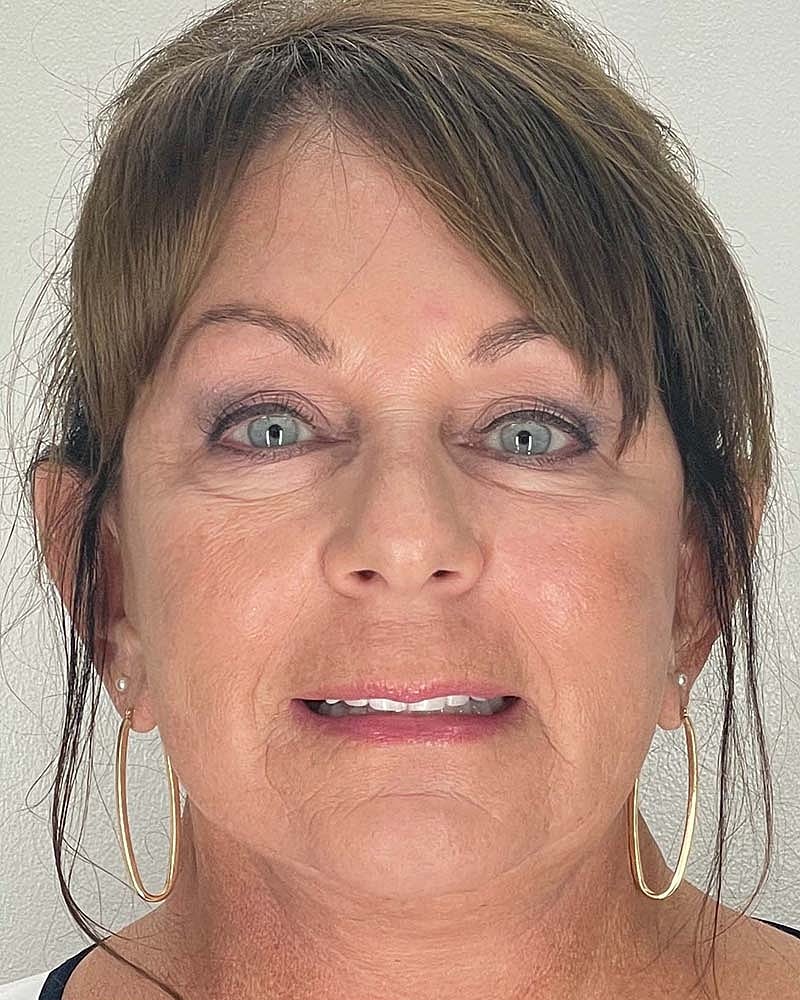 Blepharoplasty Before & After