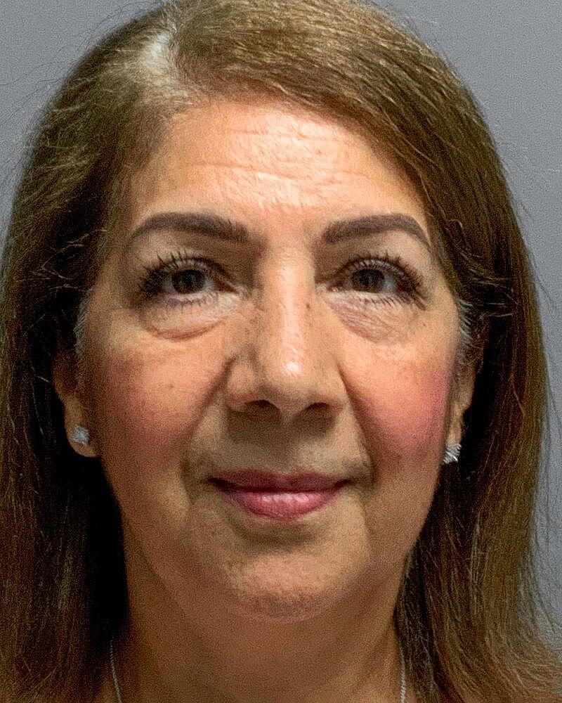 Blepharoplasty Before & After