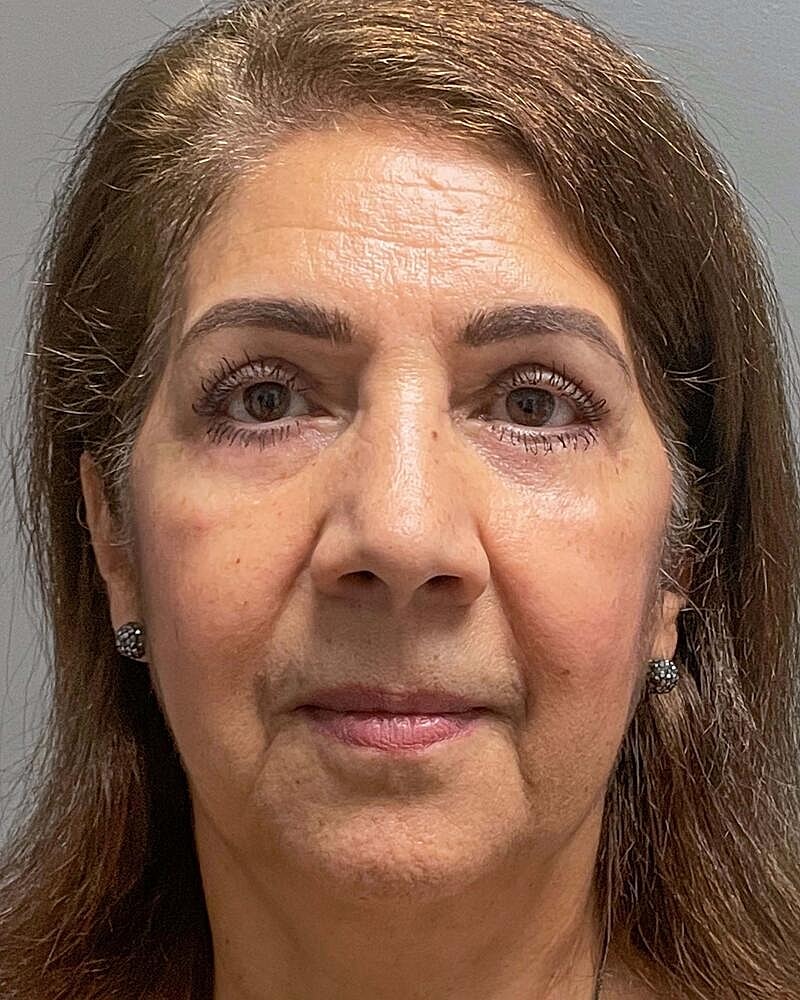 Blepharoplasty Before & After