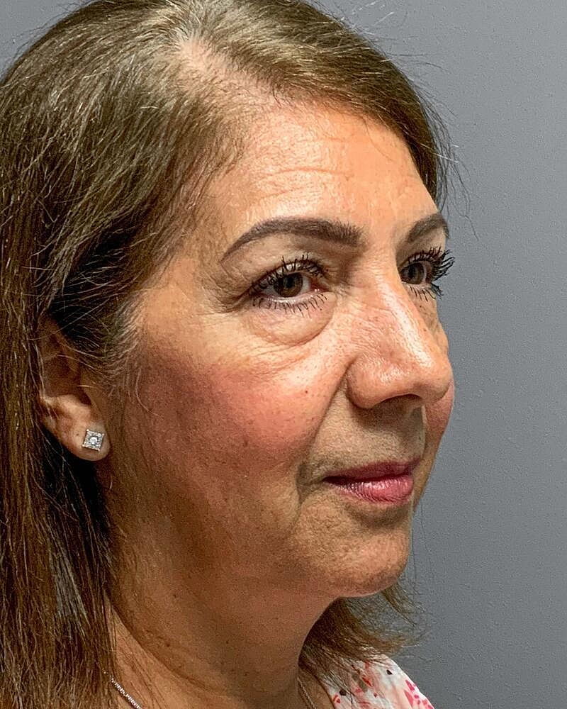 Blepharoplasty Before & After