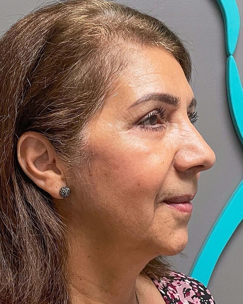Blepharoplasty Before & After