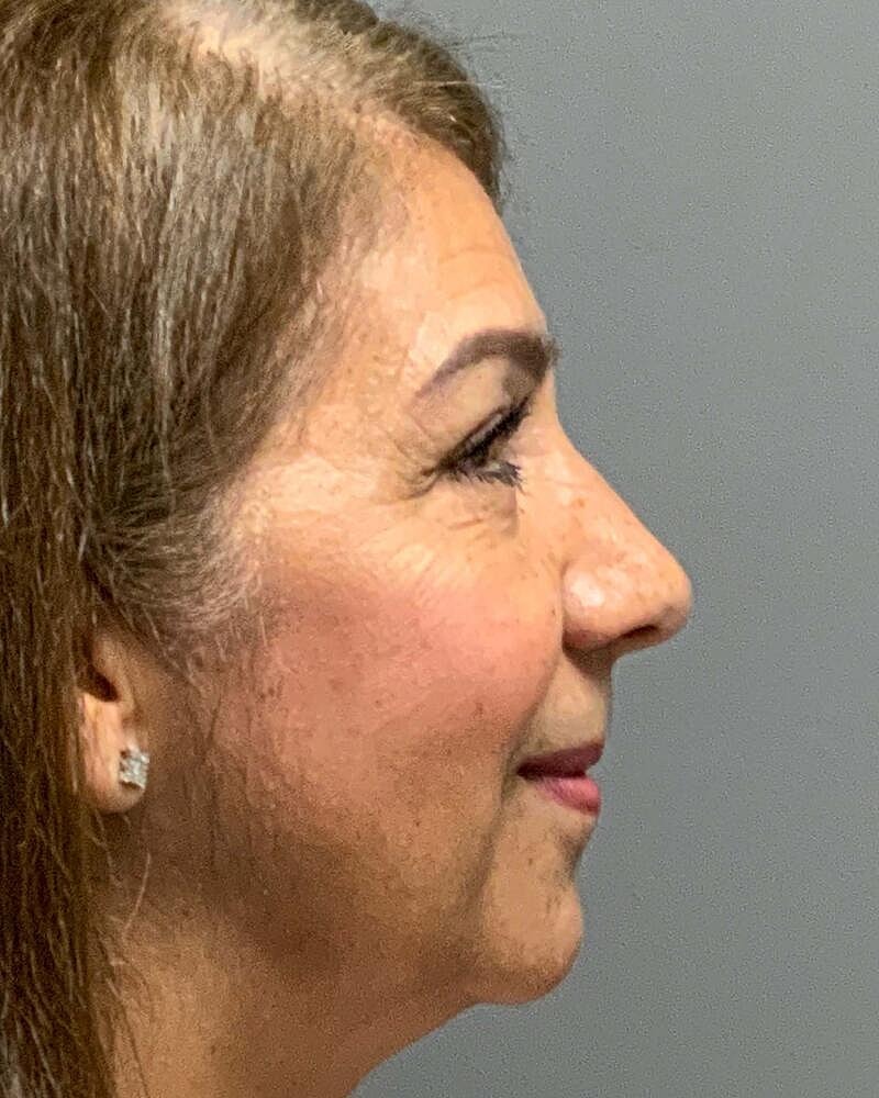 Blepharoplasty Before & After