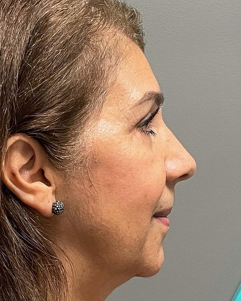 Blepharoplasty Before & After
