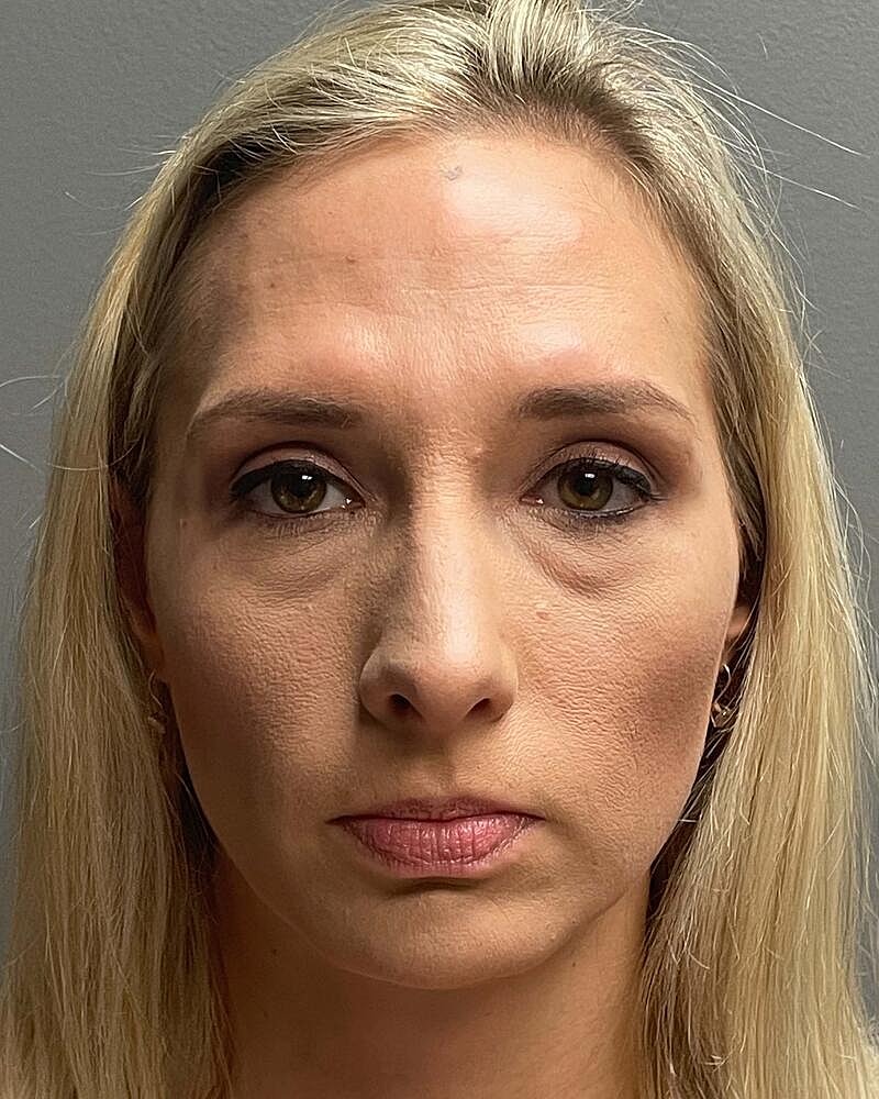 Blepharoplasty Before & After