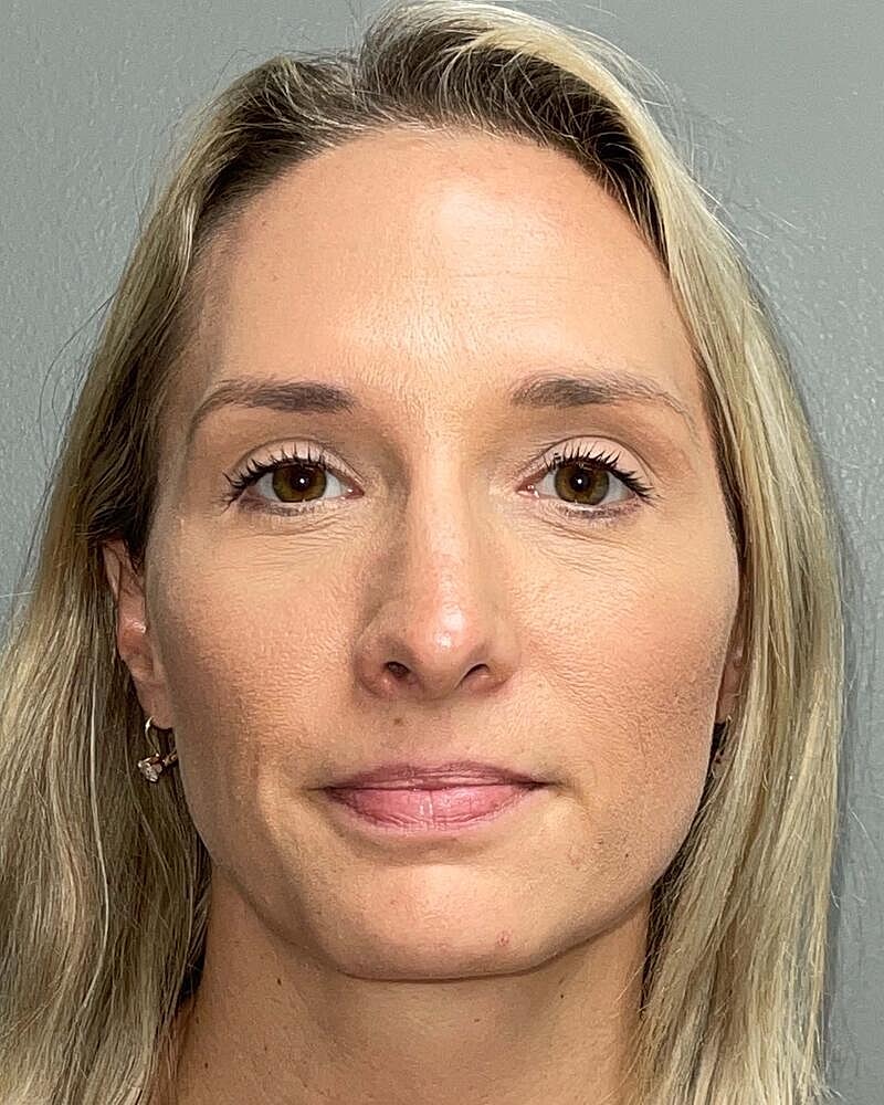 Blepharoplasty Before & After