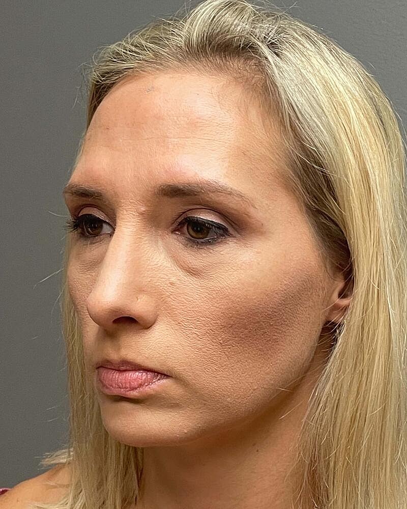 Blepharoplasty Before & After