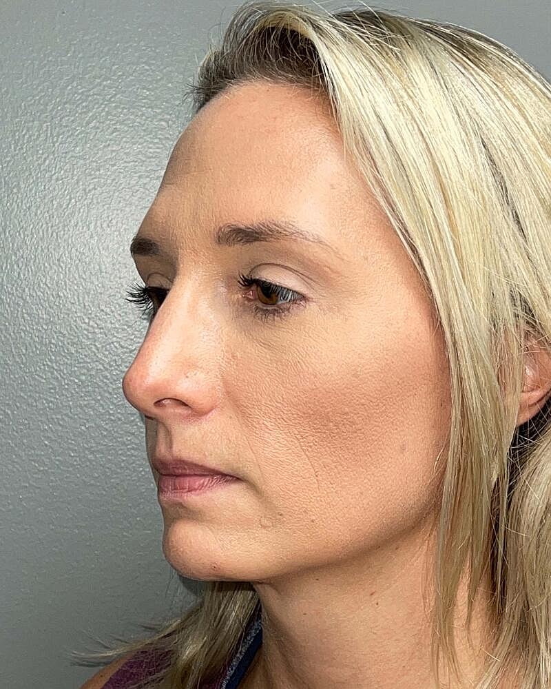 Blepharoplasty Before & After