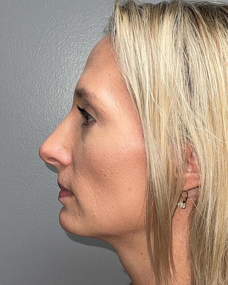 Blepharoplasty Before & After