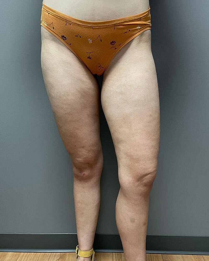 Liposuction Knees Before & After