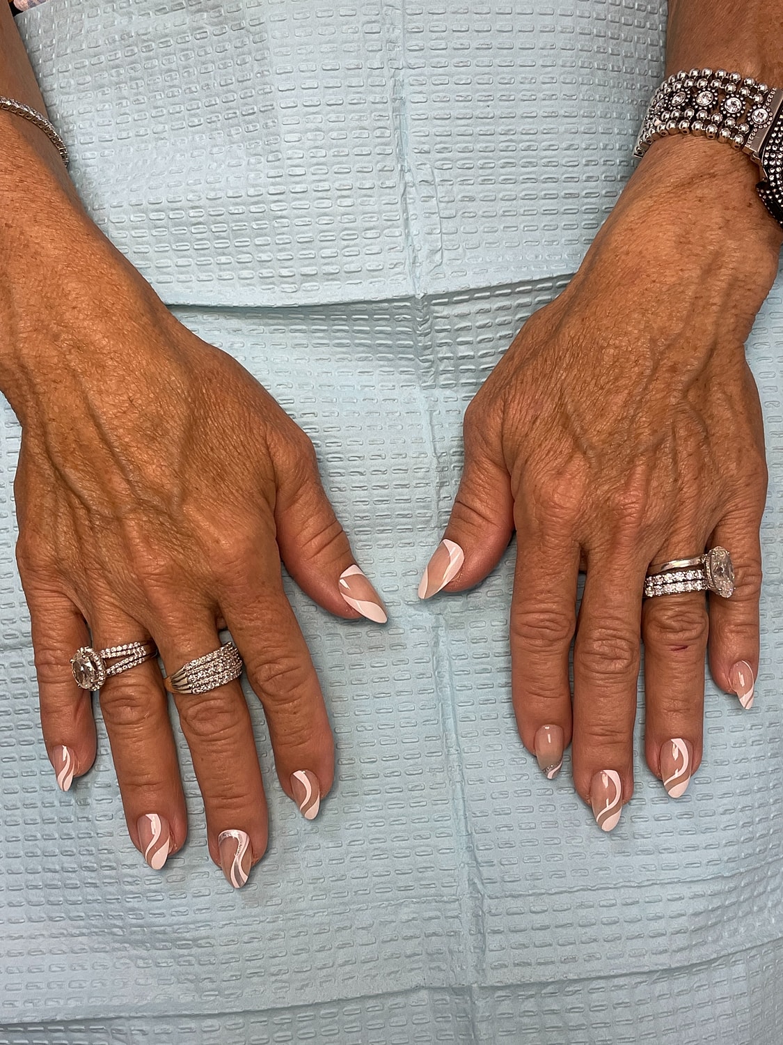 Hand Rejuvenation Before & After