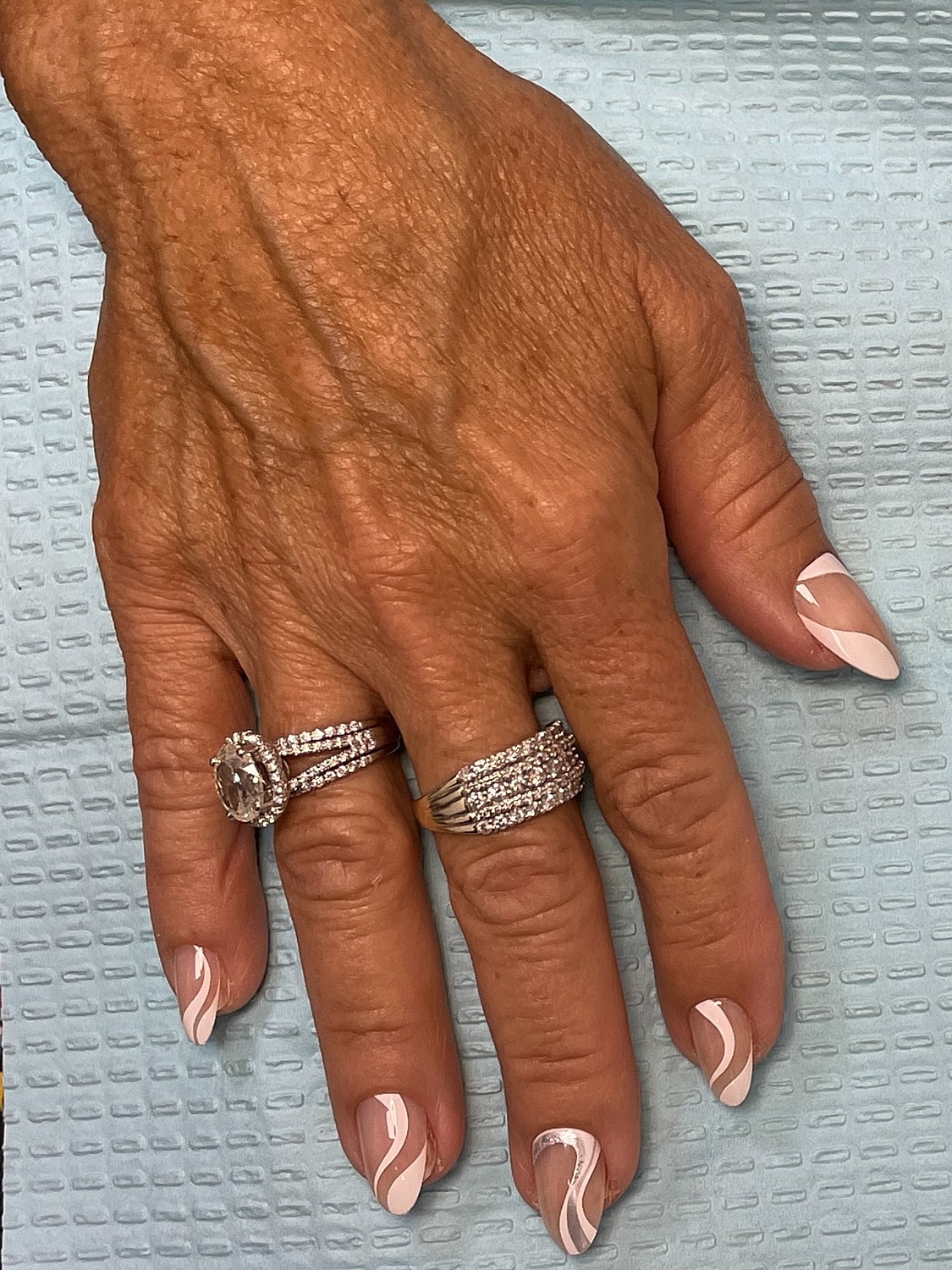 Hand Rejuvenation Before & After