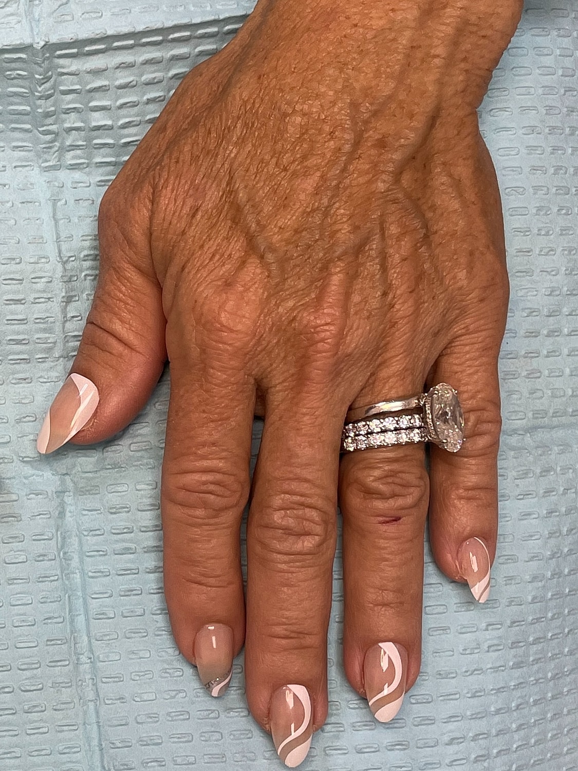 Hand Rejuvenation Before & After