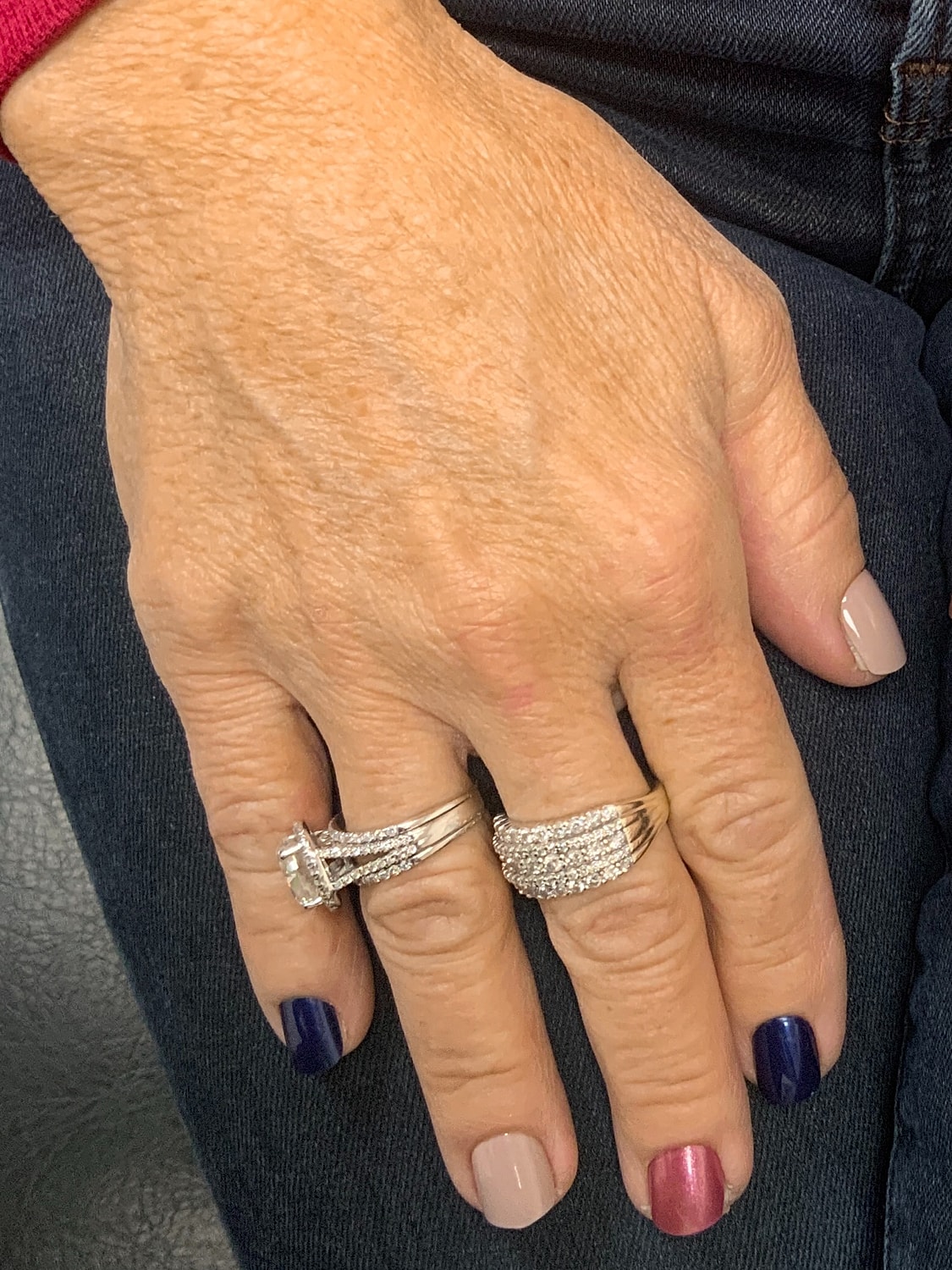 Hand Rejuvenation Before & After