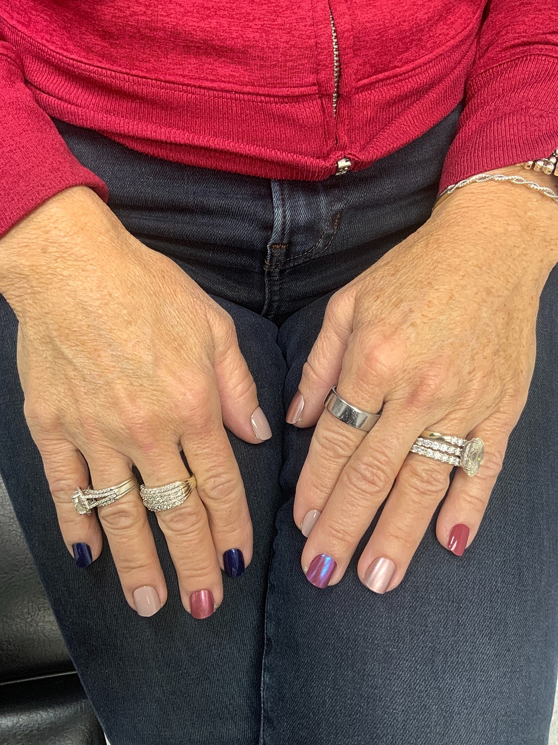 Hand Rejuvenation Before & After
