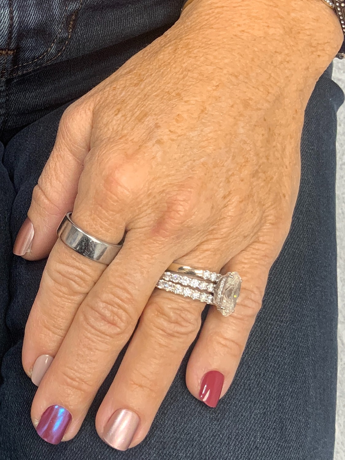 Hand Rejuvenation Before & After