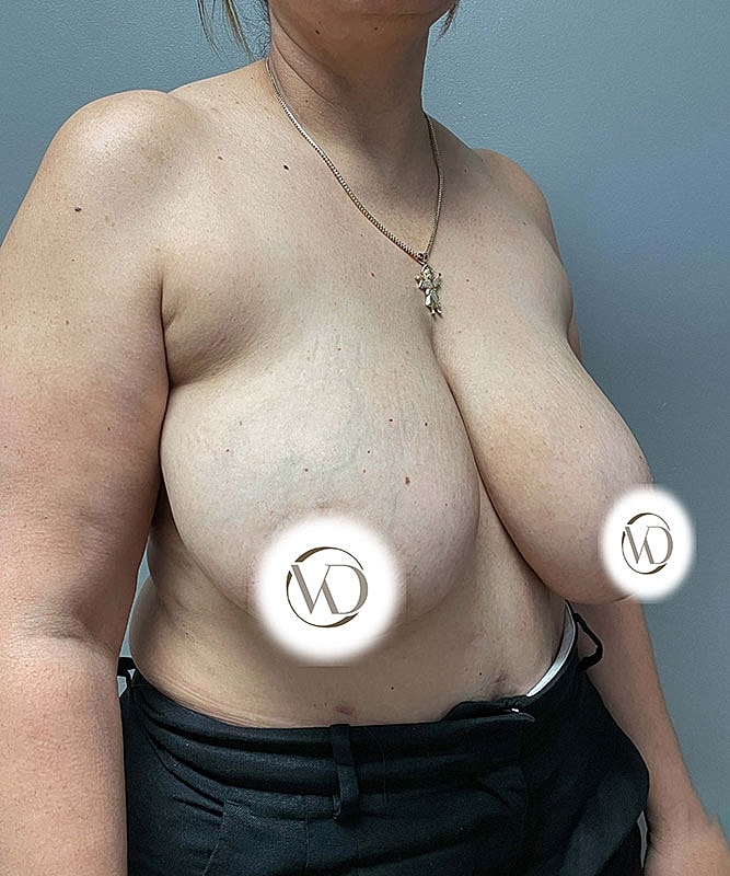 Breast Reduction Before & After