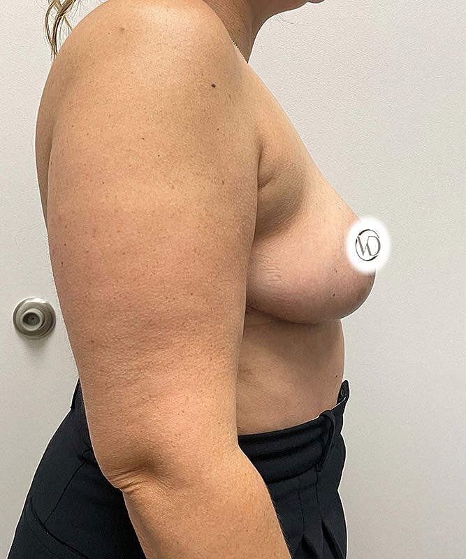 Breast Reduction Before & After