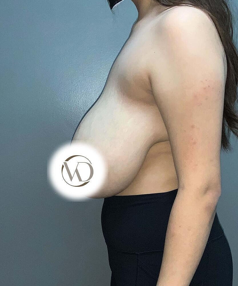 Breast Reduction Before & After
