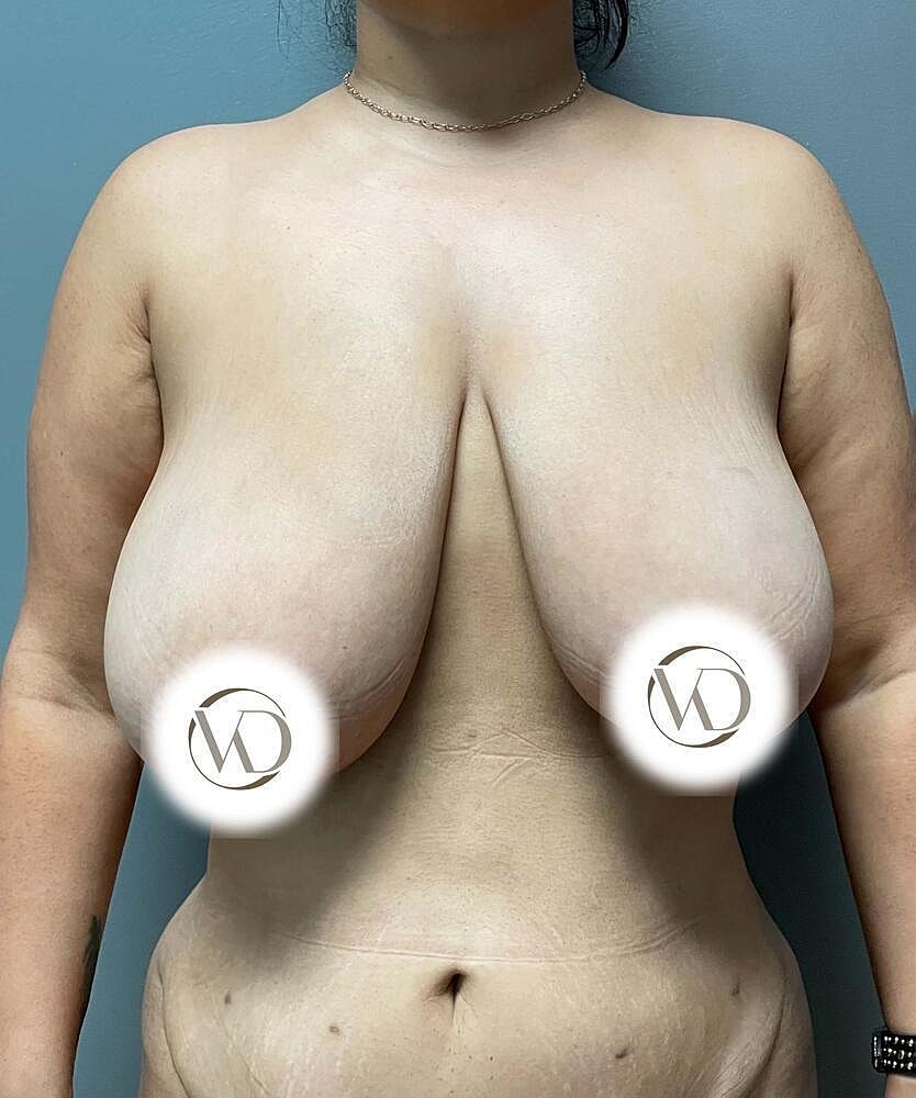 Breast Reduction Before & After