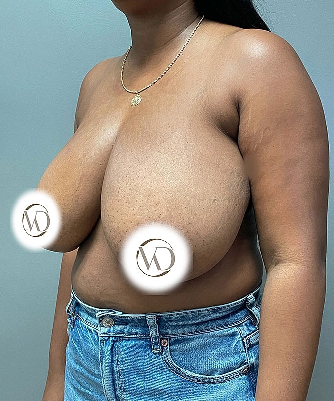 Breast Reduction Before & After