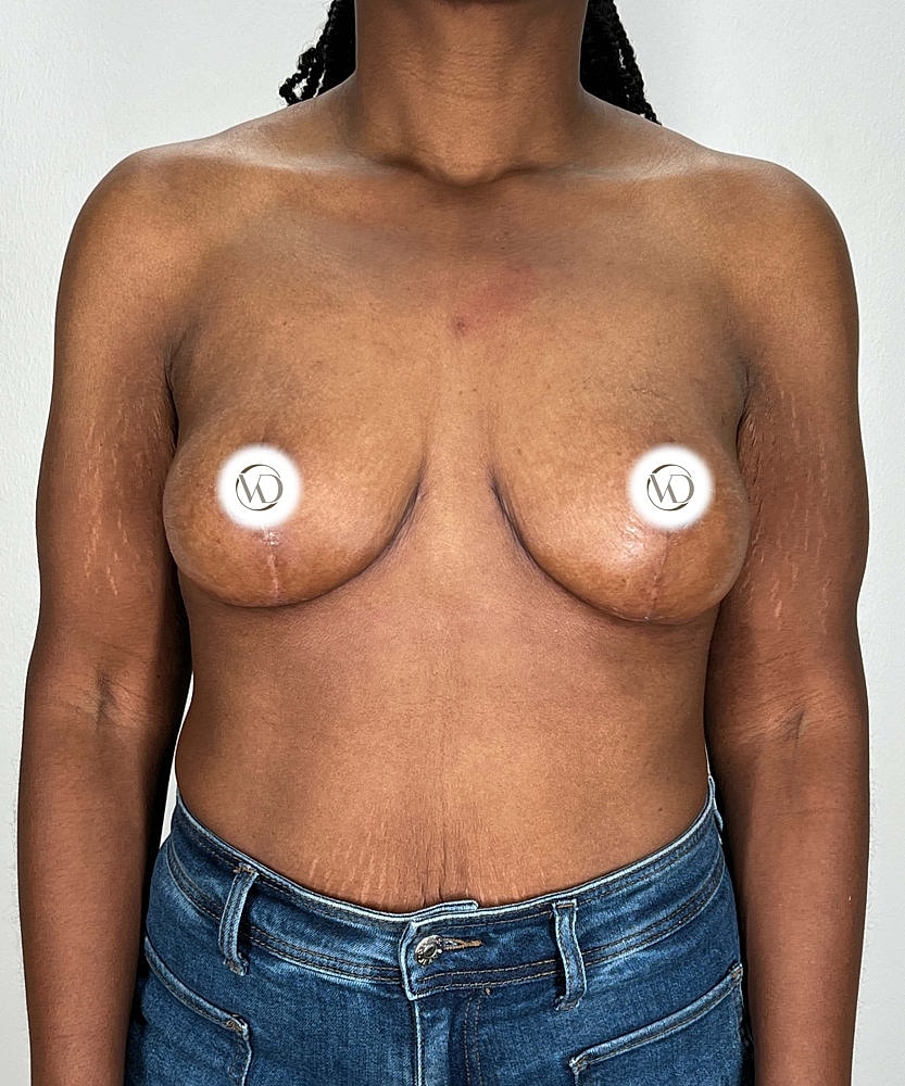 Breast Reduction Before & After