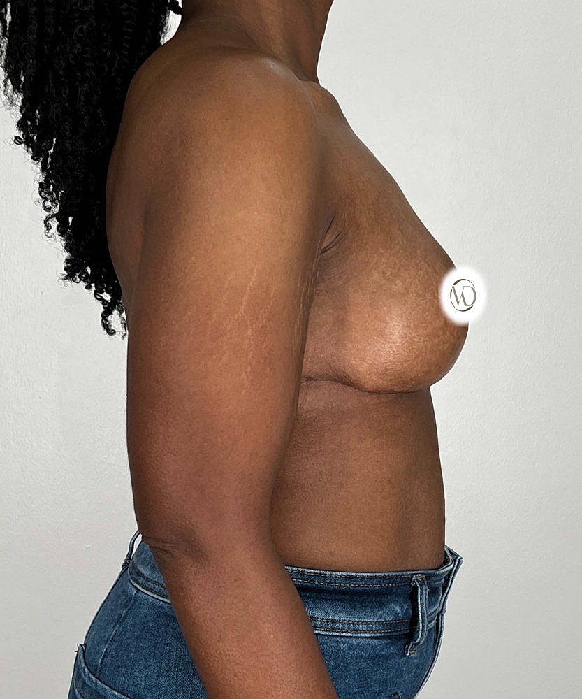 Breast Reduction Before & After