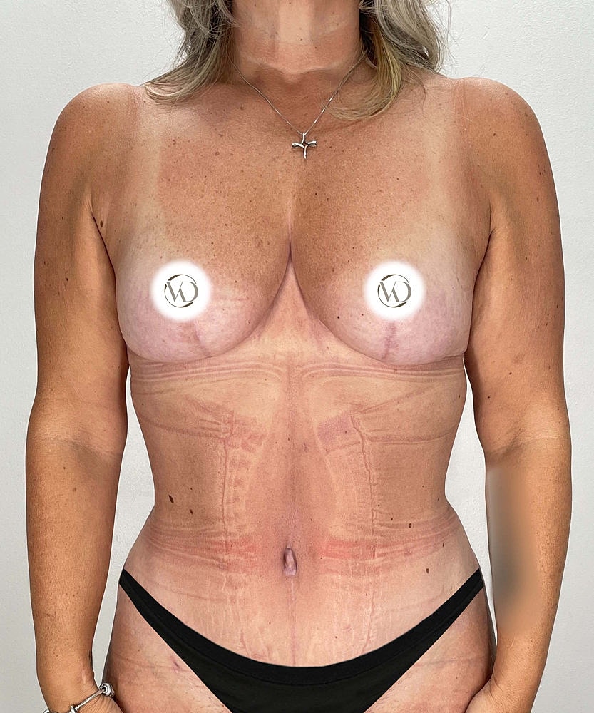 Breast Reduction Before & After