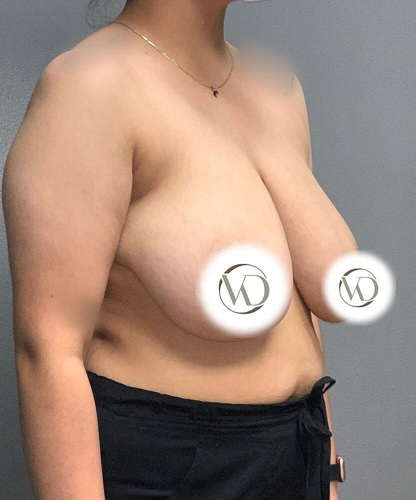 Breast Reduction Before & After