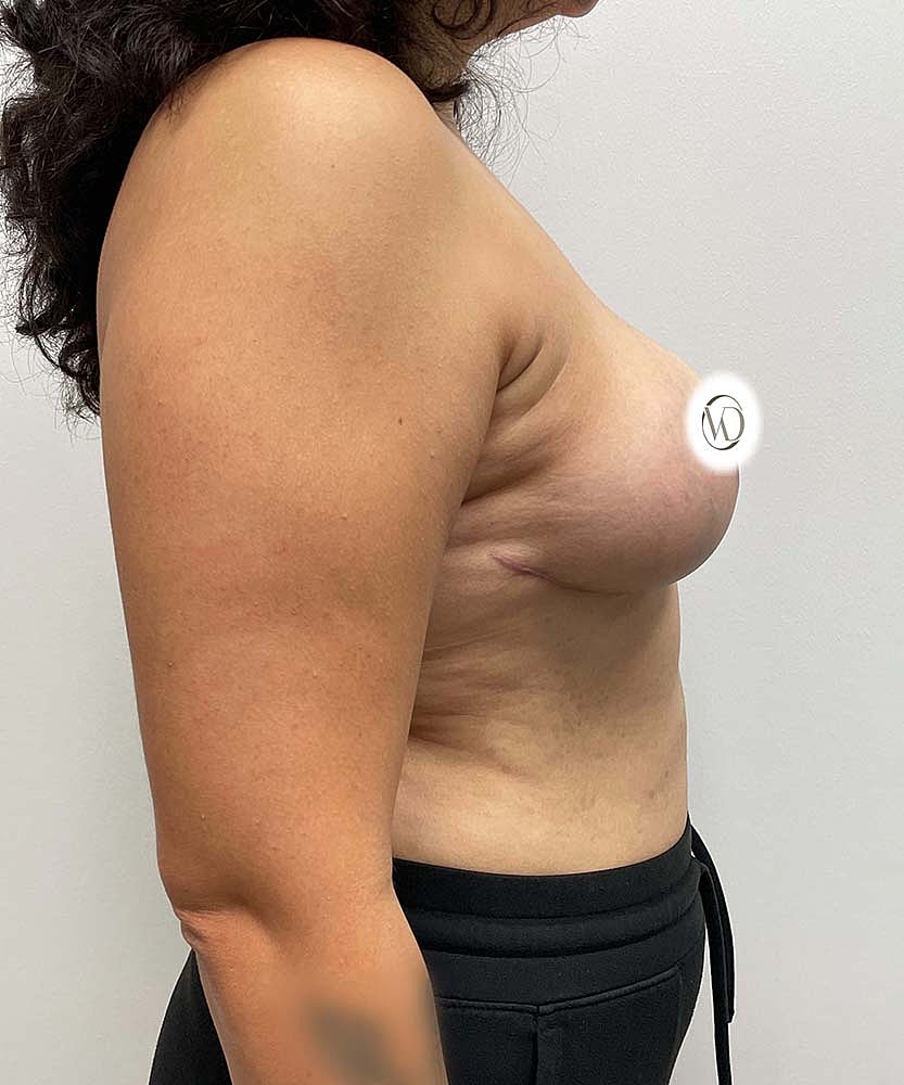 Breast Reduction Before & After