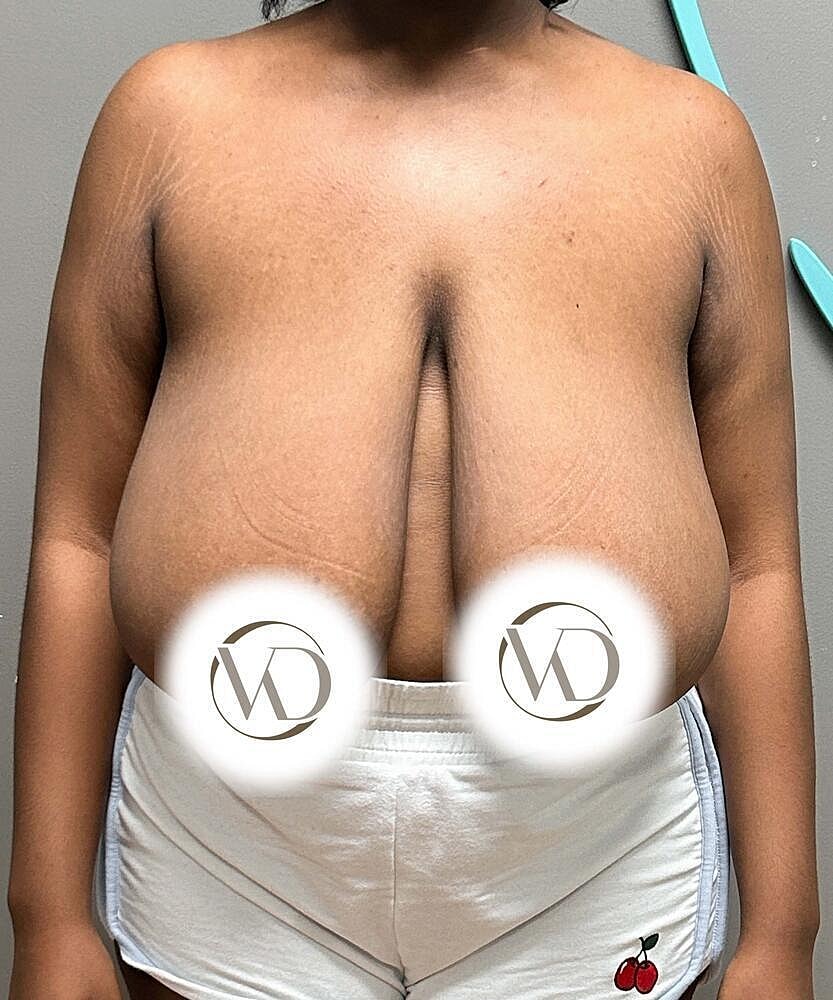 Breast Reduction Before & After