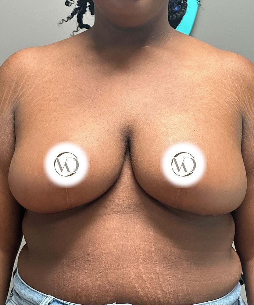 Breast Reduction Before & After