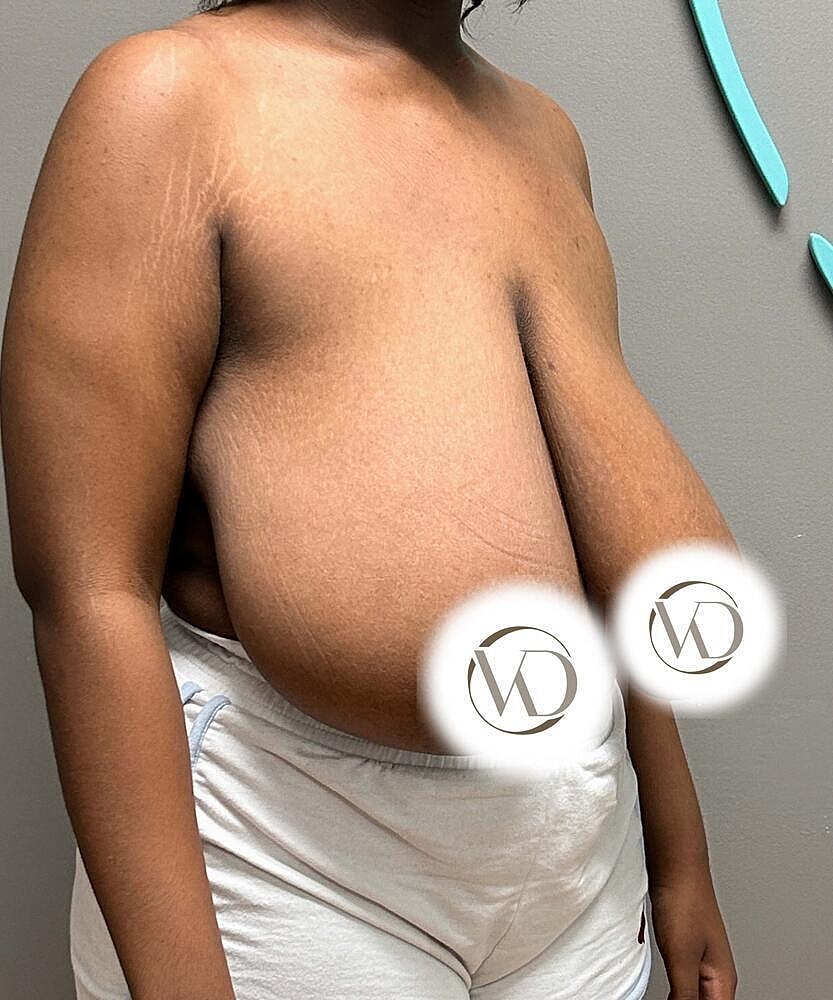 Breast Reduction Before & After
