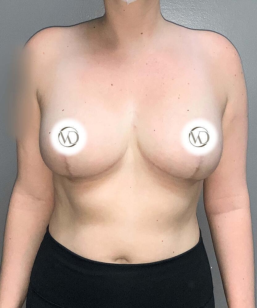 Breast Reduction Before & After