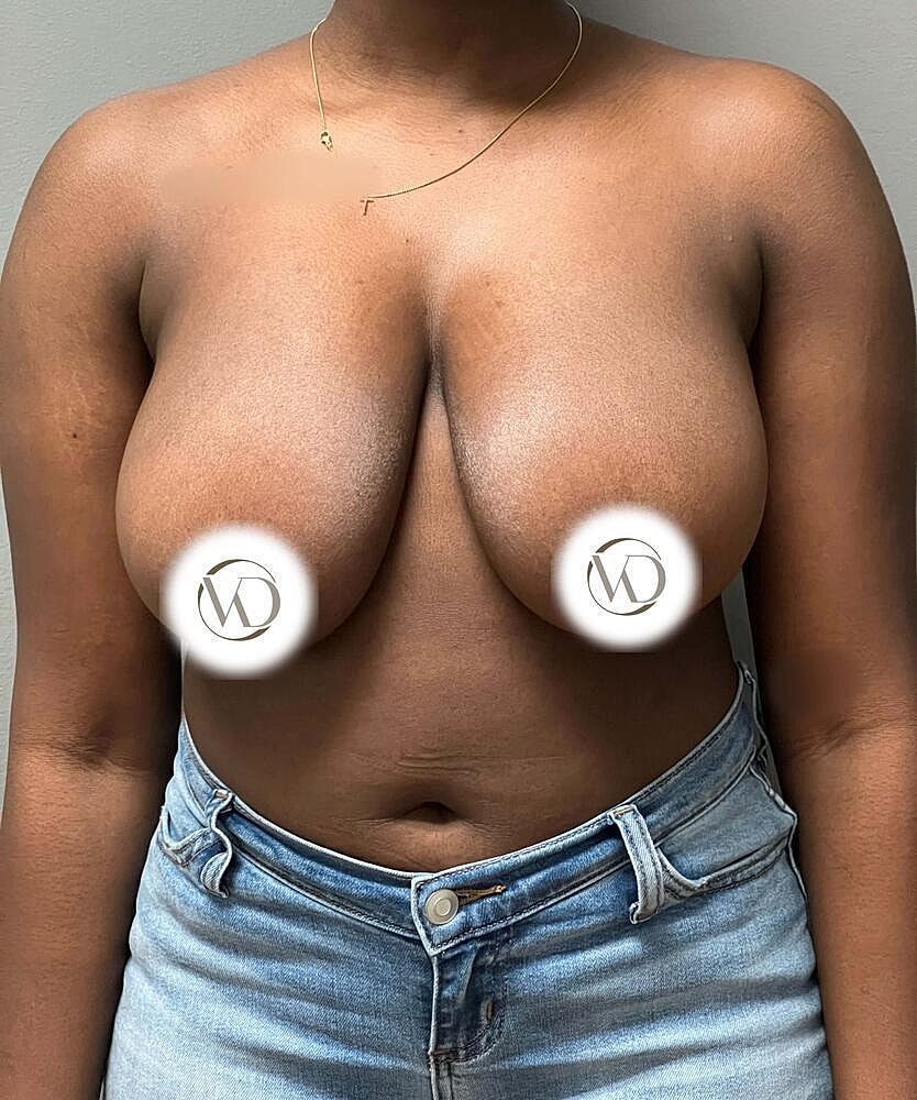 Breast Reduction Before & After