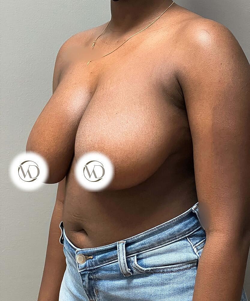 Breast Reduction Before & After