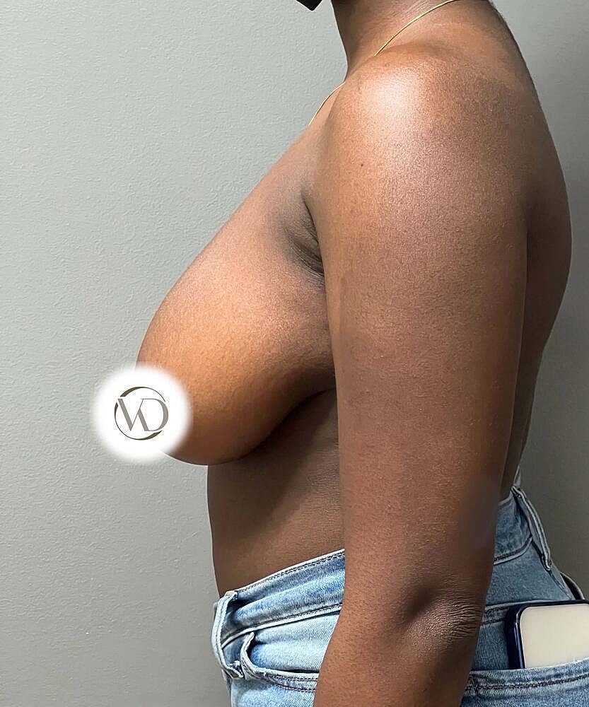 Breast Reduction Before & After