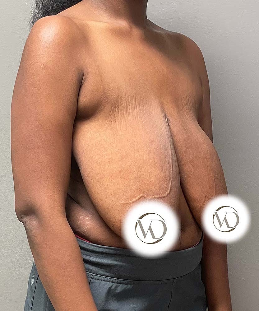Breast Reduction Before & After