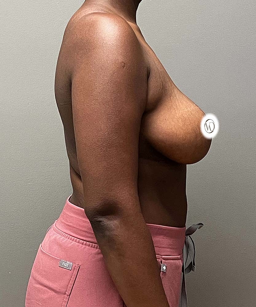 Breast Reduction Before & After