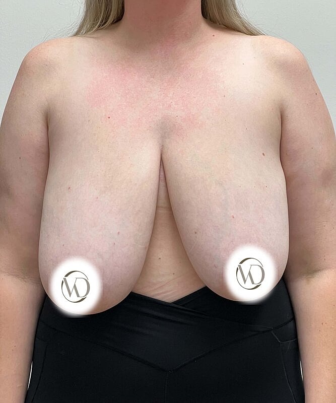 Breast Reduction Before & After