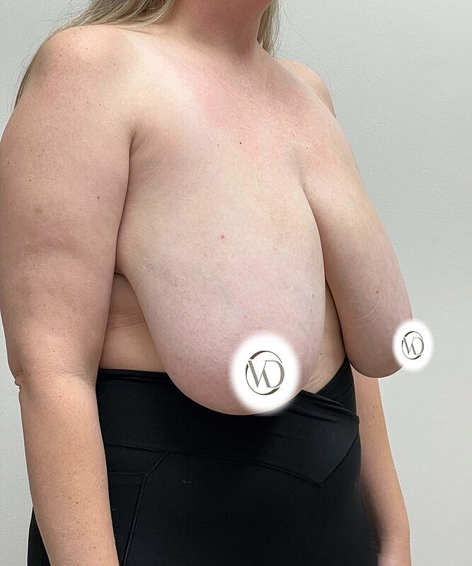 Breast Reduction Before & After