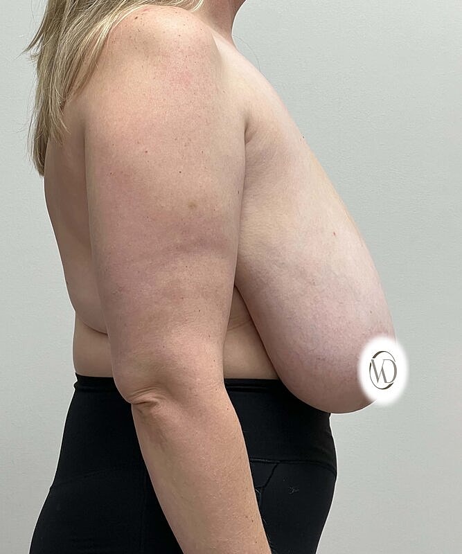 Breast Reduction Before & After