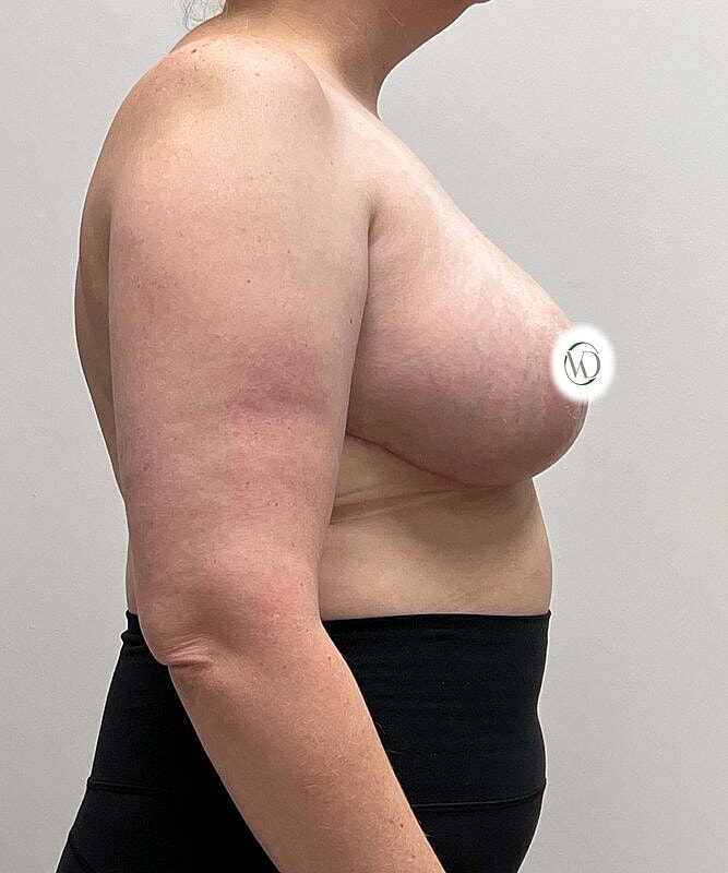 Breast Reduction Before & After