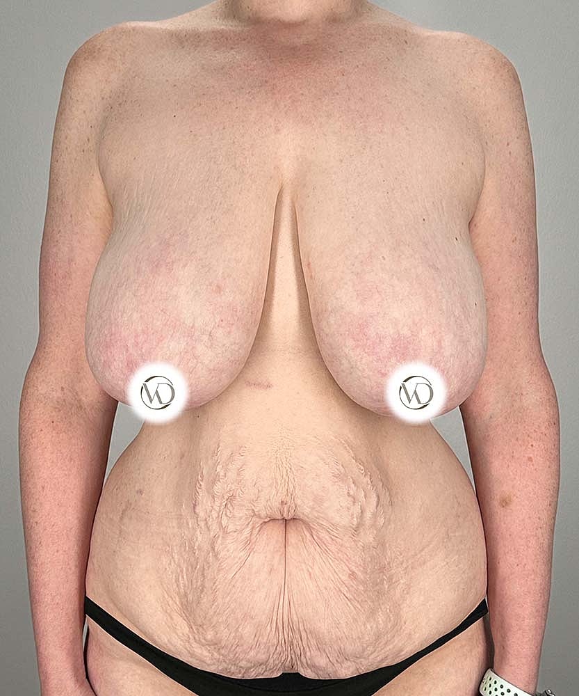 Breast Reduction Before & After