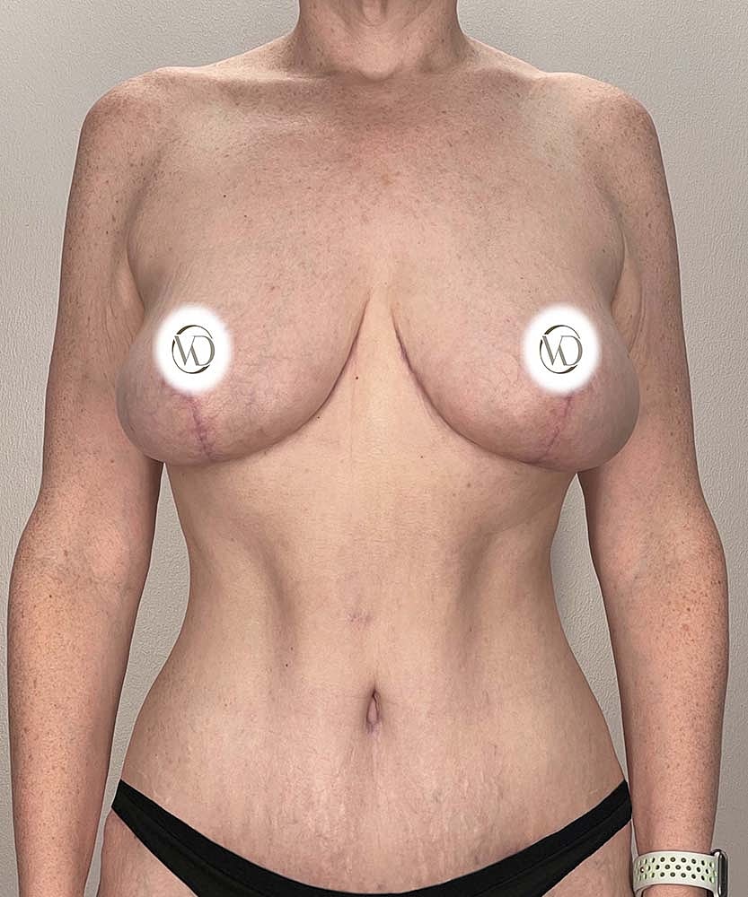 Breast Reduction Before & After