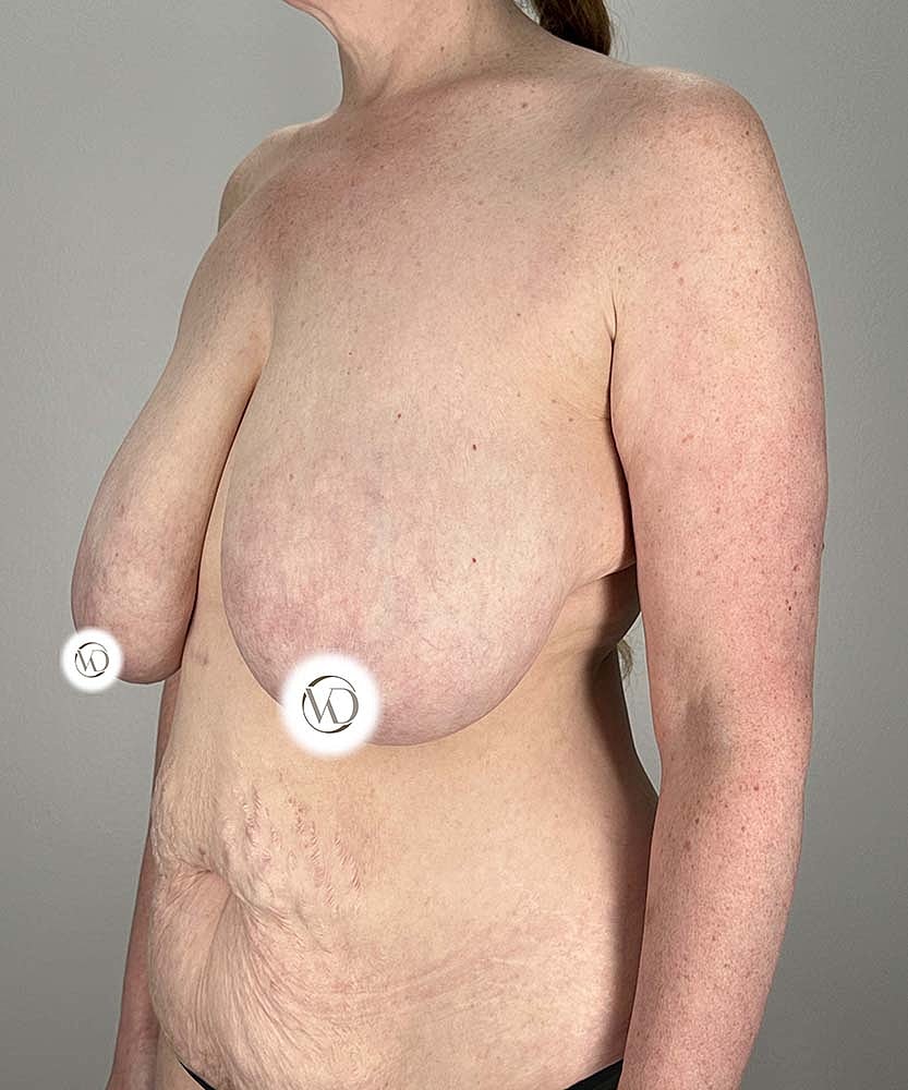 Breast Reduction Before & After