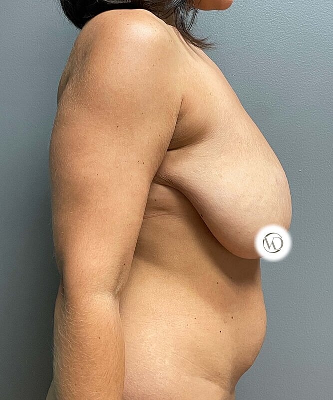 Breast Reduction Before & After