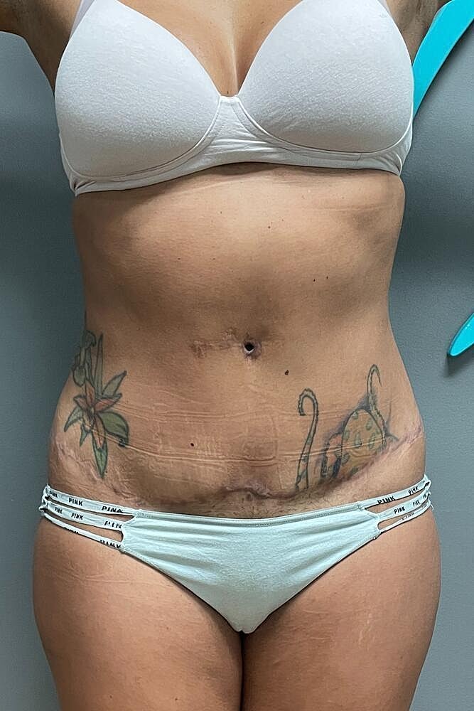 Scar Revision Before & After
