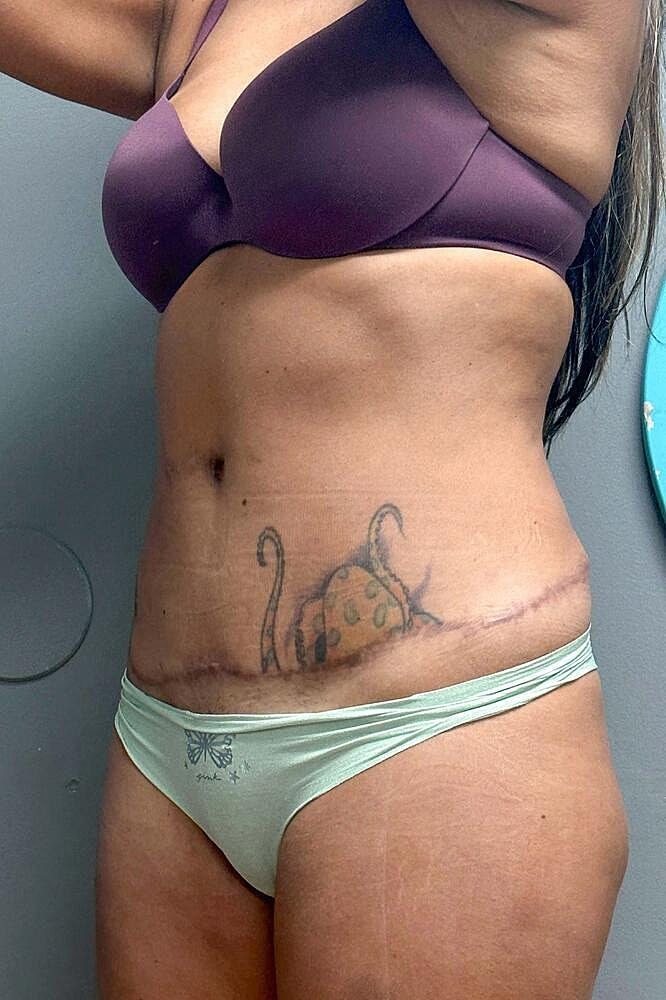 Scar Revision Before & After
